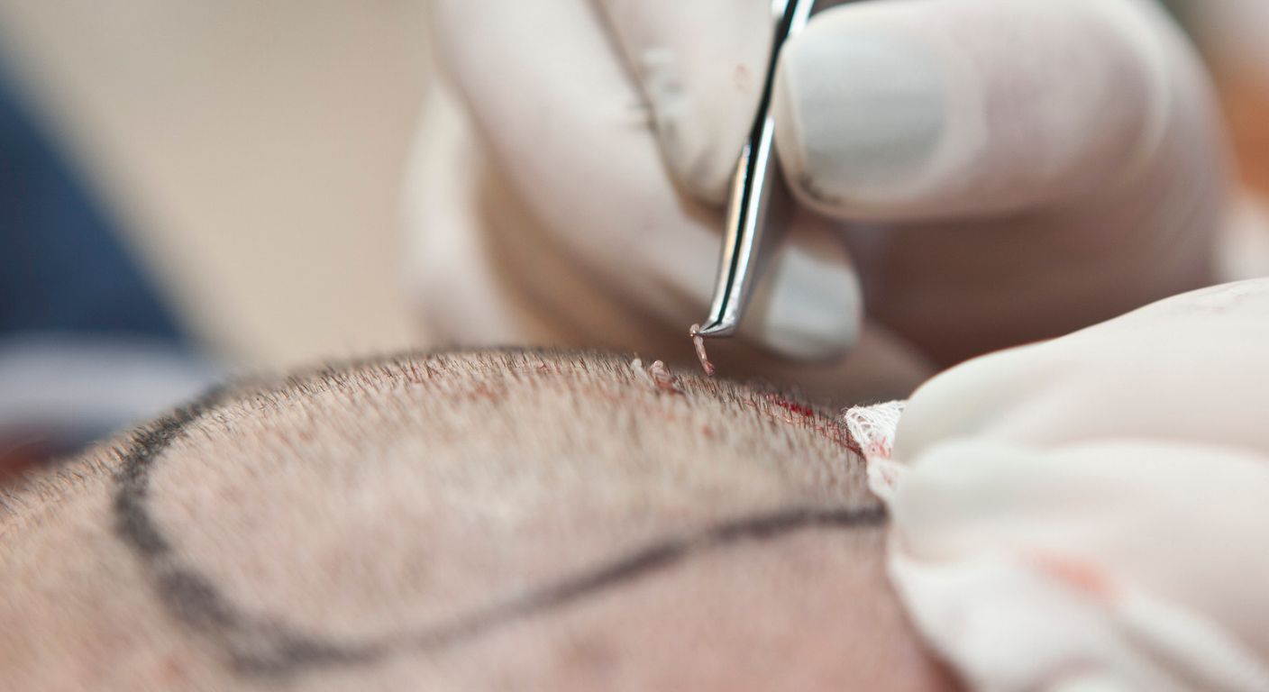 Primi giorni dopo il trapianto di capelli: cosa fare e cosa evitare
